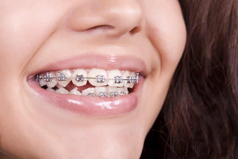 fases-brackets-metalicos fases-brackets-metalicos