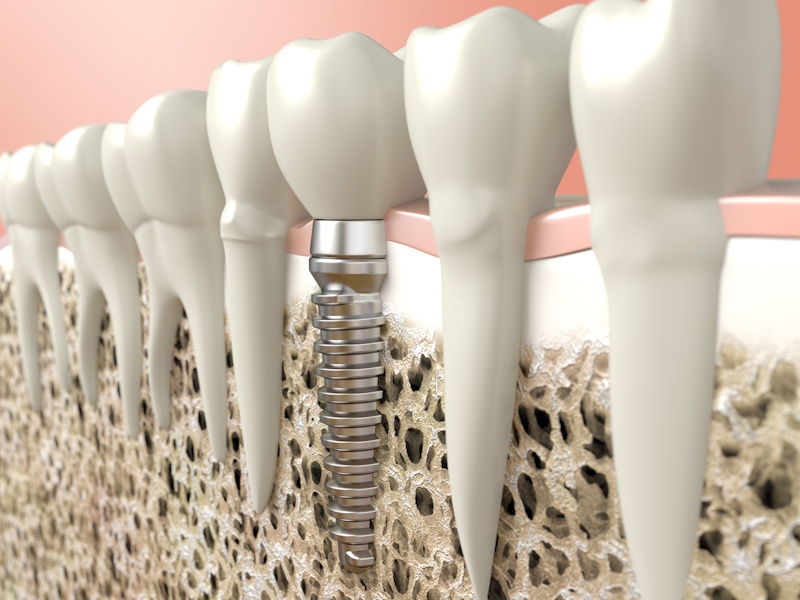 implantes-dentales-ortodentplus implantes-dentales-ortodentplus