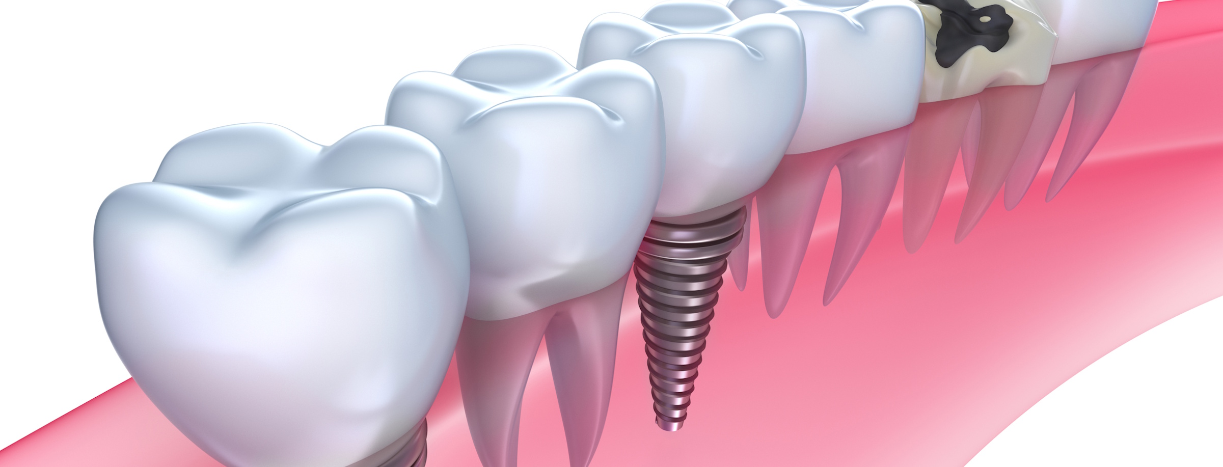 implantes-dentales implantes-dentales